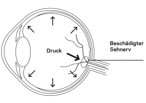 Erhöhter Innendruck beim Auge drückt auf den Sehnerv