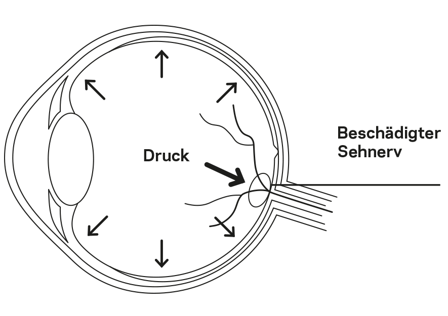 Erhöhter Innendruck beim Auge drückt auf den Sehnerv